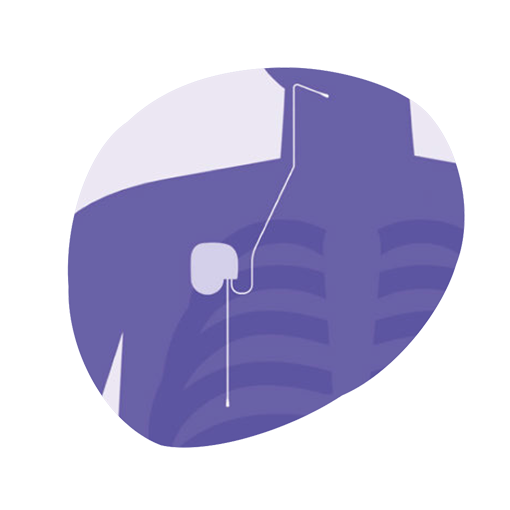Illustration of the Inspire implant under the skin of the upper chest, its lead running up to the nerve that controls the tongue